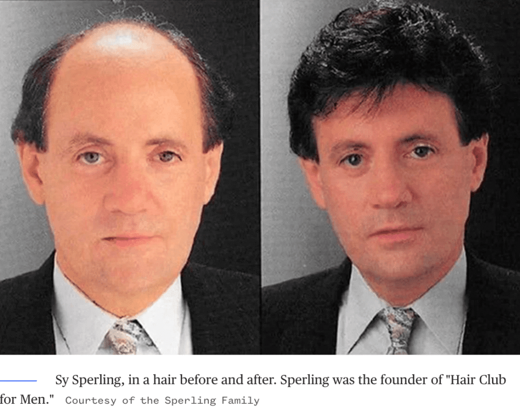 Sy Sperling hair loss